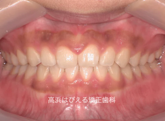 13歳女子のすきっ歯と深い噛み合わせの治療後