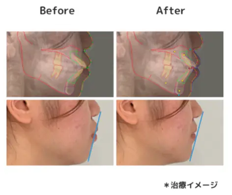 横顔の治療前後シミュレーション