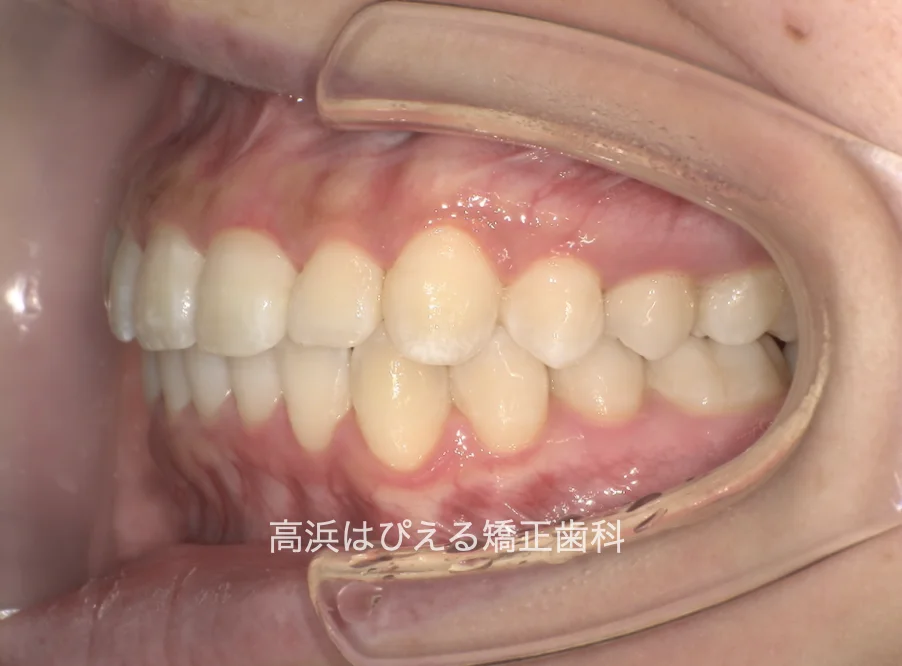 過蓋咬合症例の治療後の左側面口腔内写真