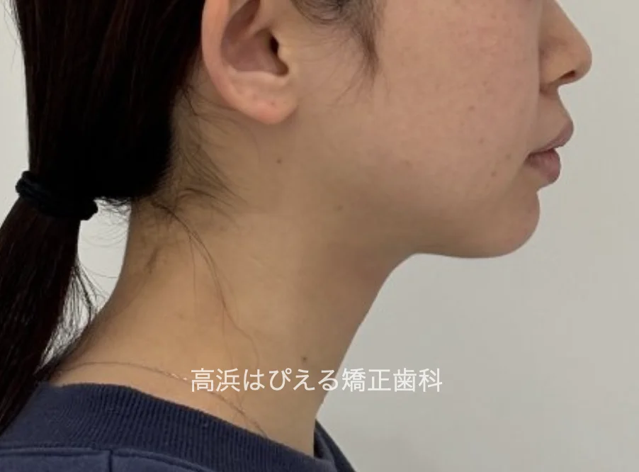 過蓋咬合症例の治療後の横顔の口元
