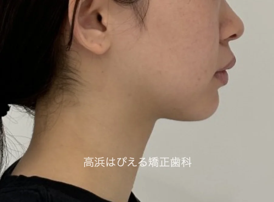 過蓋咬合症例の治療前の横顔の口元
