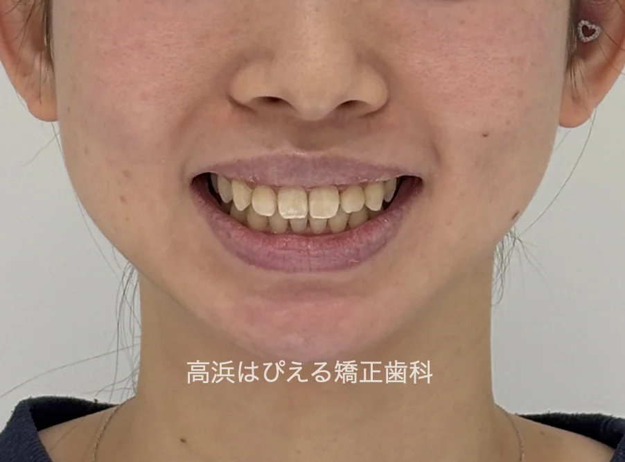 過蓋咬合症例の治療後の口元
