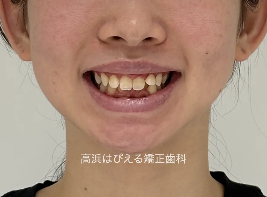 過蓋咬合症例の治療前の口元