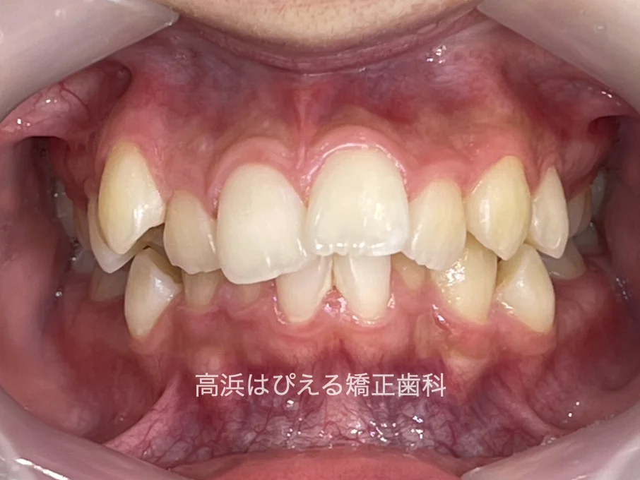 19歳女性の深い噛み合わせ症例の治療前の正面口腔内写真