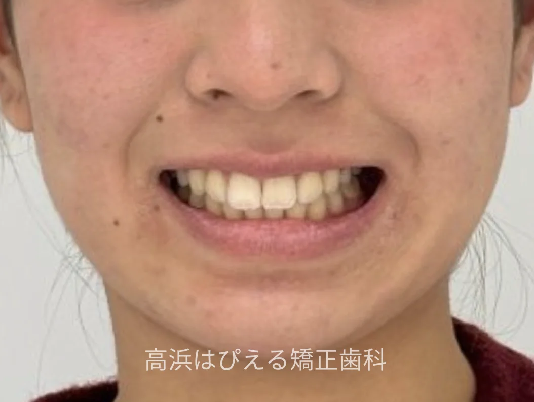 19歳女性の深い噛み合わせ症例の治療後の口元写真