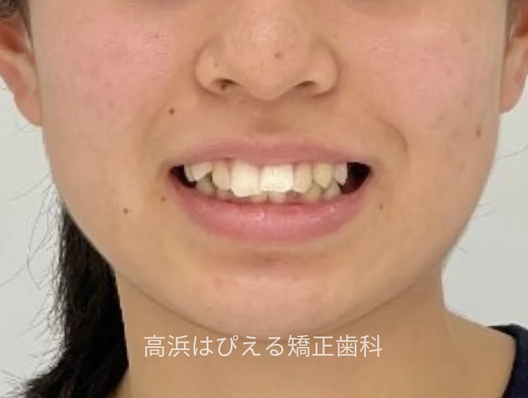 19歳女性の深い噛み合わせ症例の治療前の口元写真