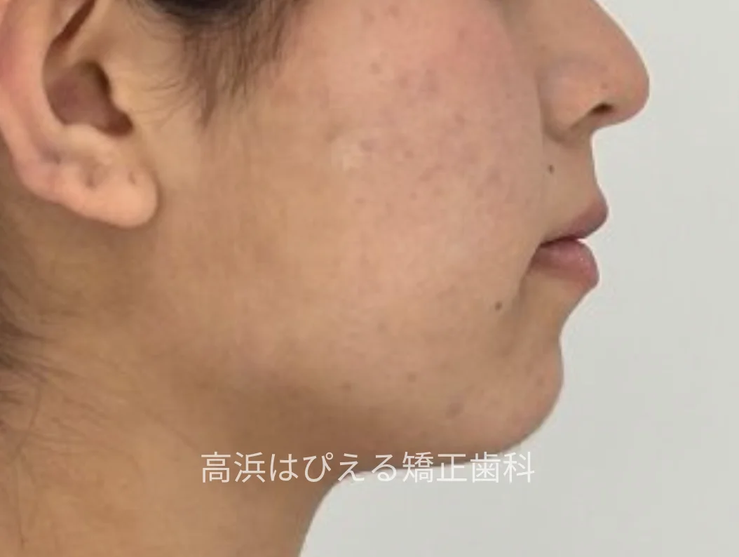 19歳女性の深い噛み合わせ症例の治療後の横顔写真