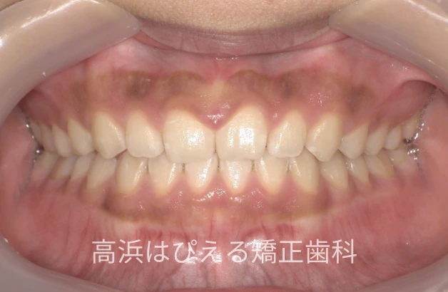 13歳女子のすきっ歯・深い噛み合わせの治療後の正面口腔内写真