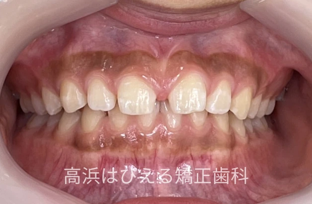 13歳女子のすきっ歯・深い噛み合わせの治療前の正面口腔内写真