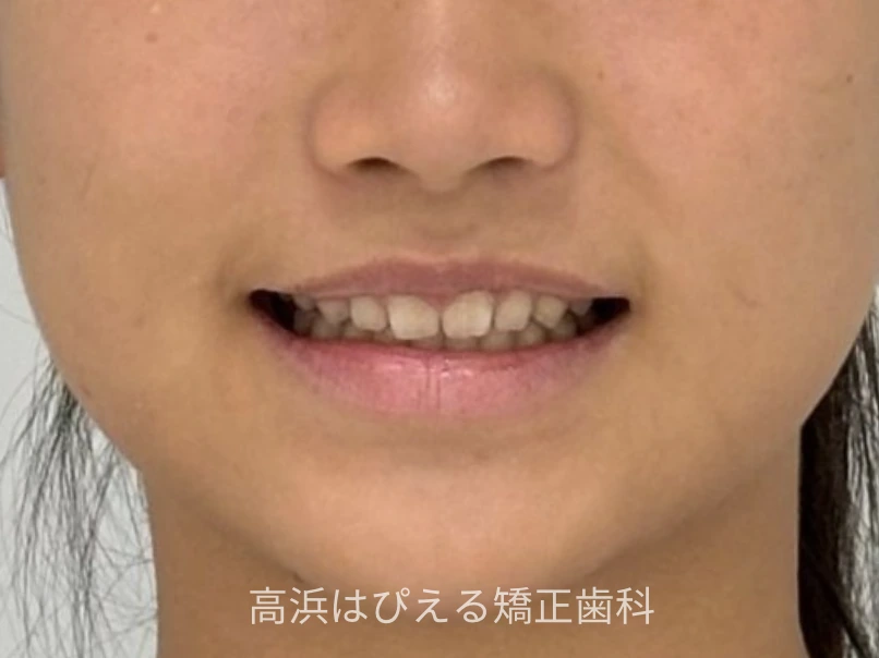 噛み合わせが深い症例の治療後の口元写真