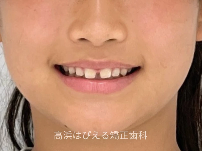 噛み合わせが深い症例の治療前の口元写真