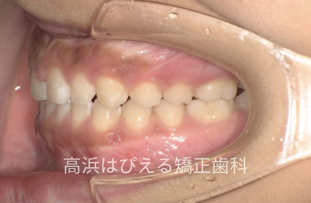 噛み合わせが深い症例の治療後の左側面口腔内写真