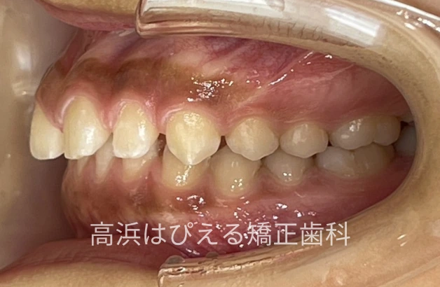 噛み合わせが深い症例の治療前の左側面口腔内写真