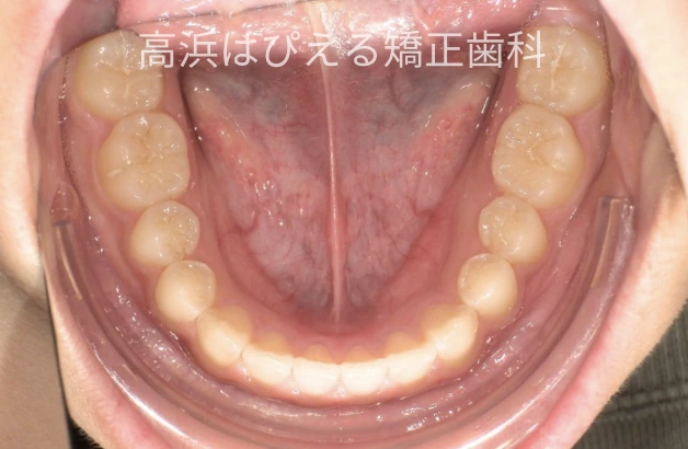 噛み合わせが深い症例の治療後の下顎咬合面写真