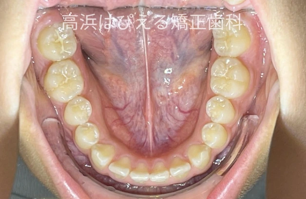 噛み合わせが深い症例の治療前の下顎咬合面写真