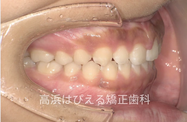 噛み合わせが深い症例の治療後の右側面口腔内写真