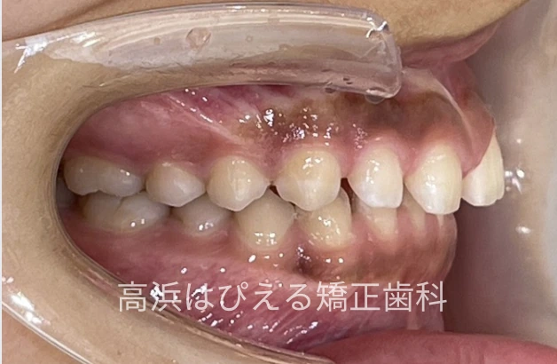 噛み合わせが深い症例の治療前の右側面口腔内写真
