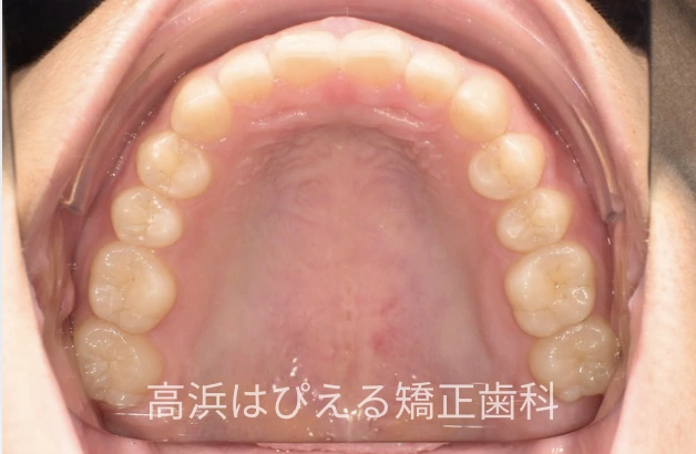 噛み合わせが深い症例の治療後の上顎咬合面写真