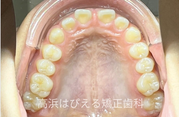 噛み合わせが深い症例の治療前の上顎咬合面写真