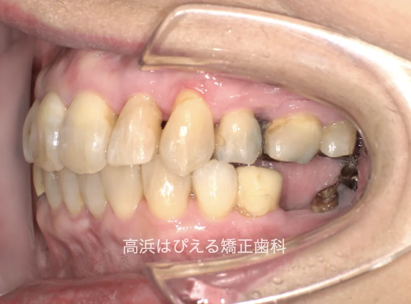 50代女性の欠損歯・ガタガタの治療後の左側面口腔内写真