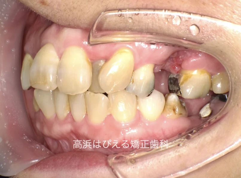 50代女性の欠損歯・ガタガタの治療前の左側面口腔内写真