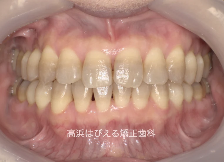 50代女性のガタガタ・深い噛み合わせの治療後
