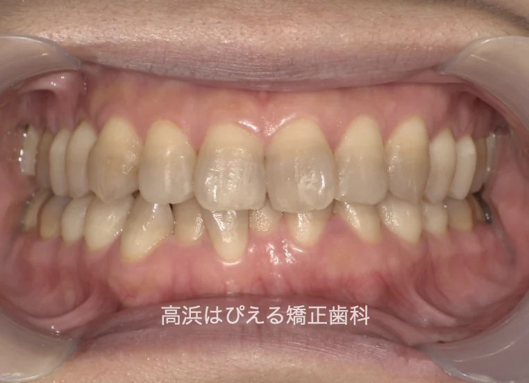 50代女性のガタガタ・深い噛み合わせの治療前