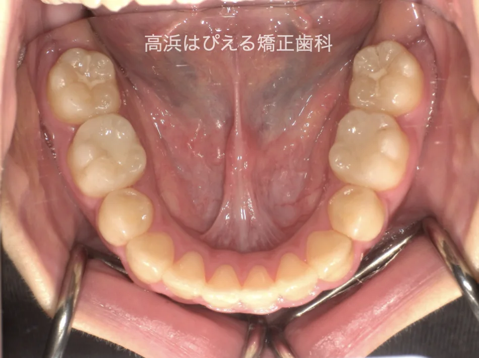 15歳女性の開咬症例の治療後の下顎咬合面口腔内写真