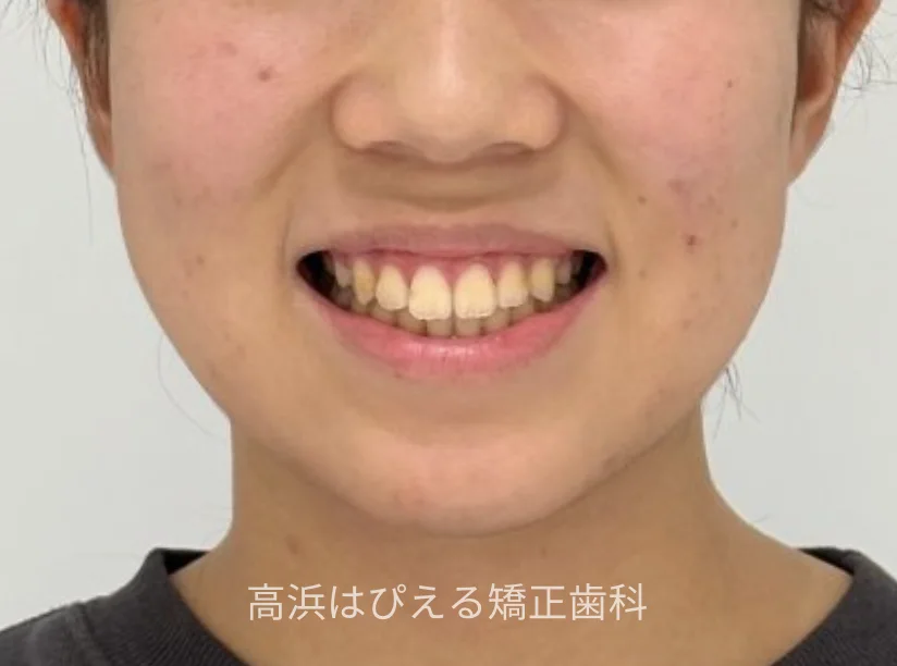 15歳女性の開咬症例の治療後の口元（スマイル）写真