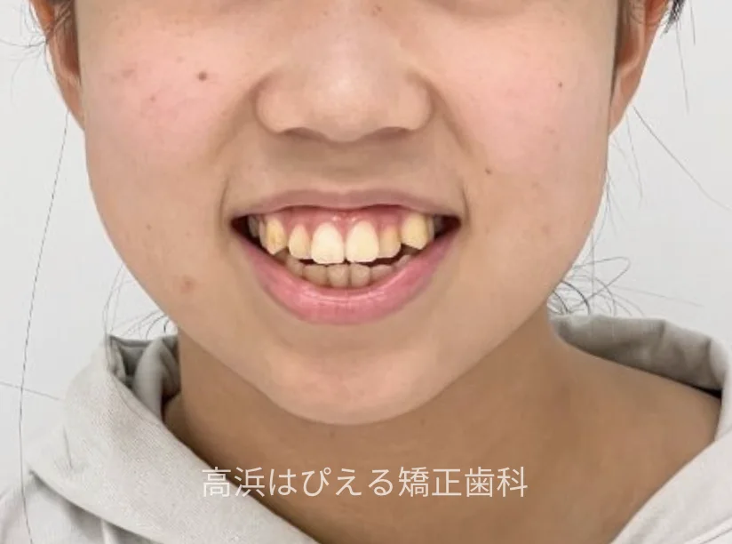 15歳女性の開咬症例の治療前の口元（スマイル）写真