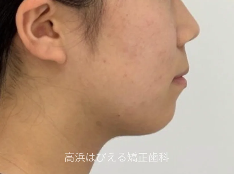 15歳女性の開咬症例の治療後の横顔写真