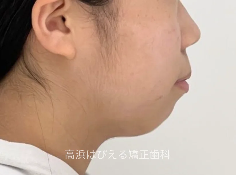 15歳女性の開咬症例の治療前の横顔写真