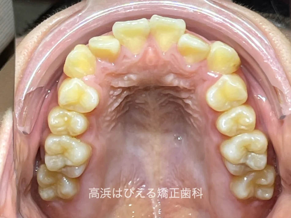 15歳女性の開咬症例の治療前の上顎咬合面口腔内写真