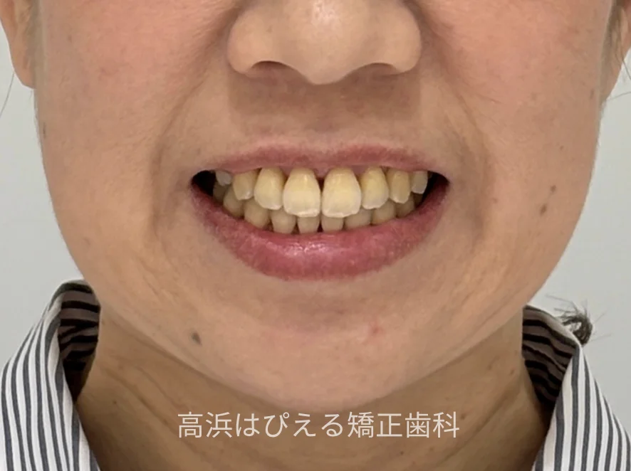 44歳女性の開咬症例の治療後の口元