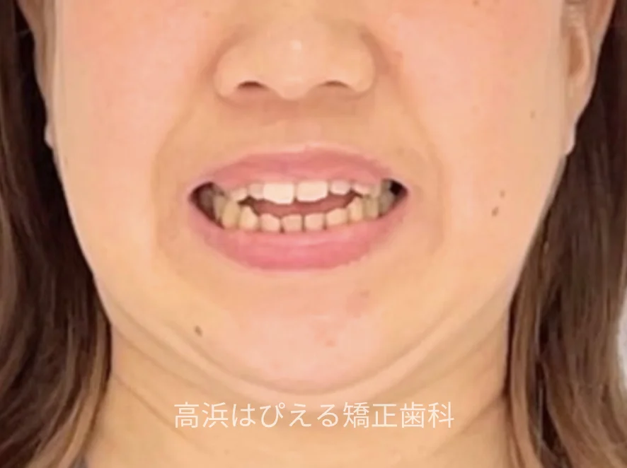 44歳女性の開咬症例の治療前の口元