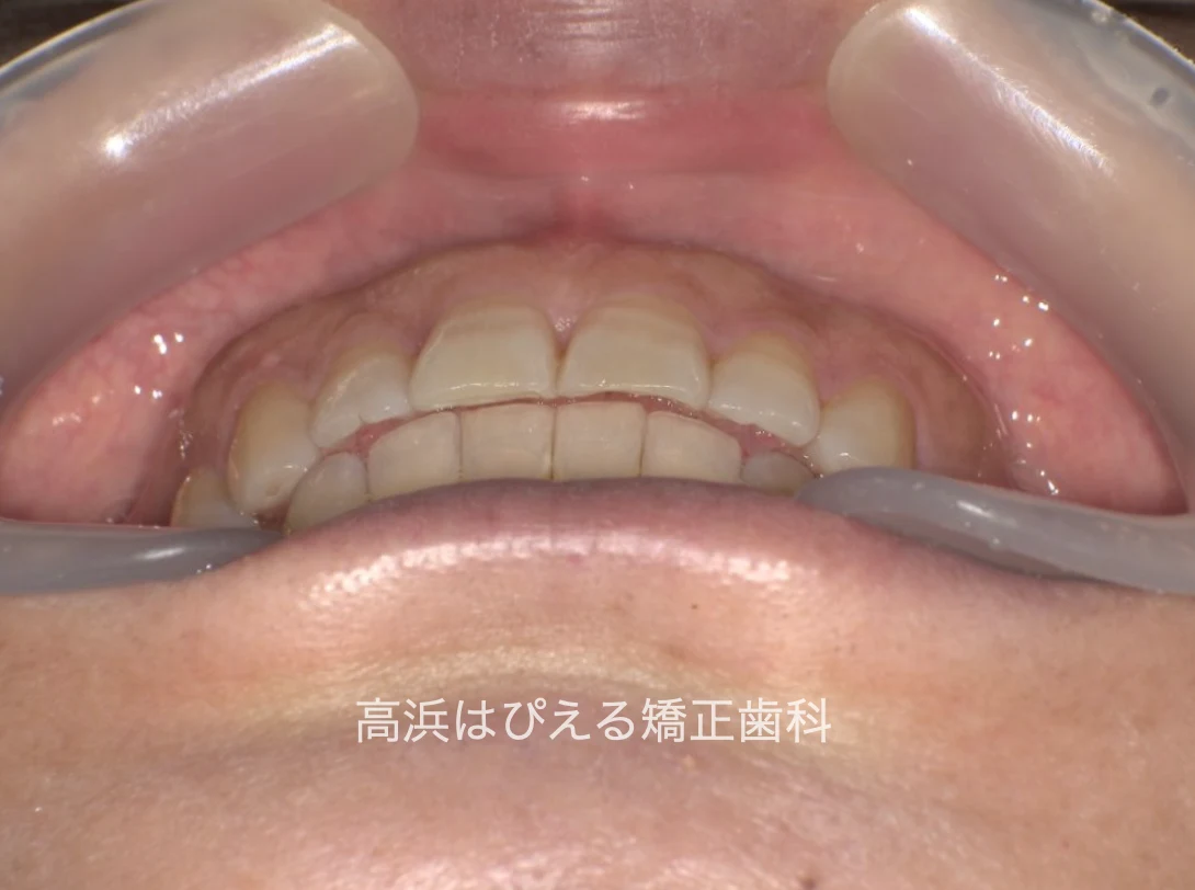 開咬症例の治療後に前歯で咬合している状態