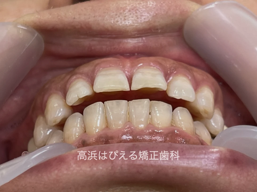 開咬症例の治療前の前歯部咬合状態