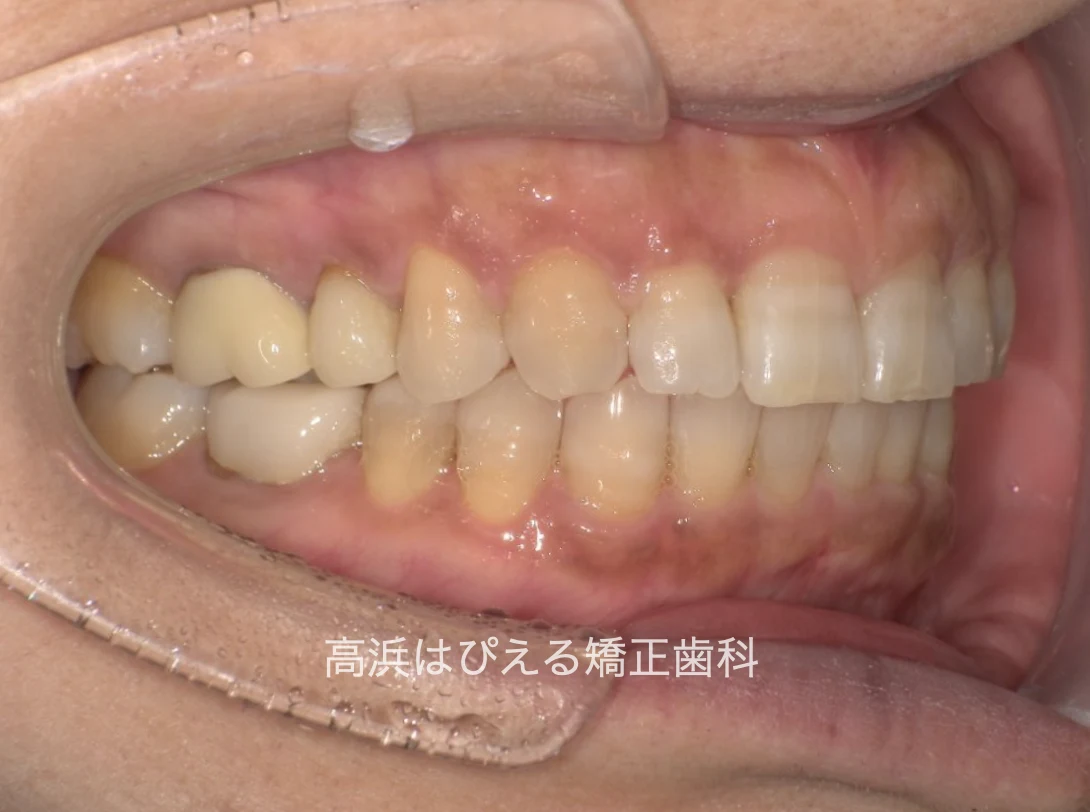 開咬・出っ歯症例の治療後の右側面口腔内写真