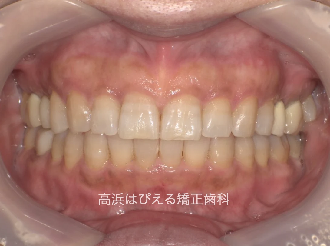 50代女性のすきっ歯・出っ歯・開咬の治療後の正面口腔内写真