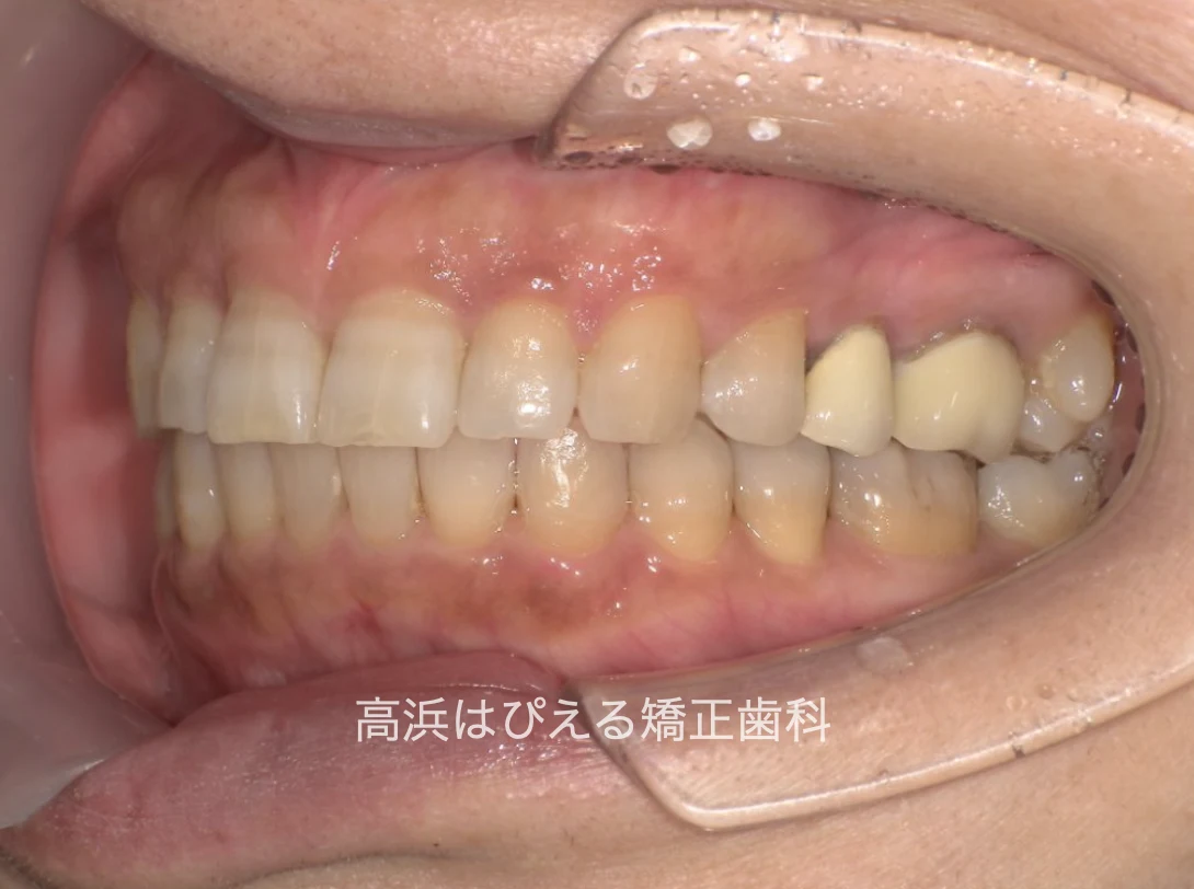 開咬症例の治療後の左側面口腔内写真