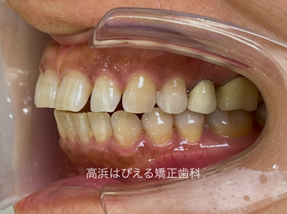 開咬症例の治療前の左側面口腔内写真
