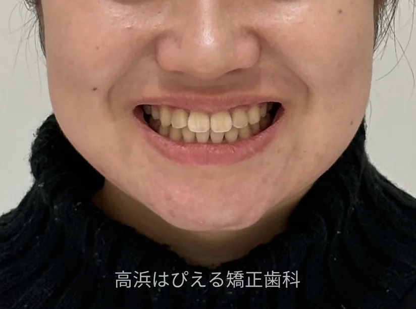 出っ歯・口ゴボ症例3の治療後の口元（スマイル）写真