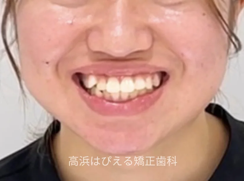 出っ歯・口ゴボ症例3の治療前の口元（スマイル）写真