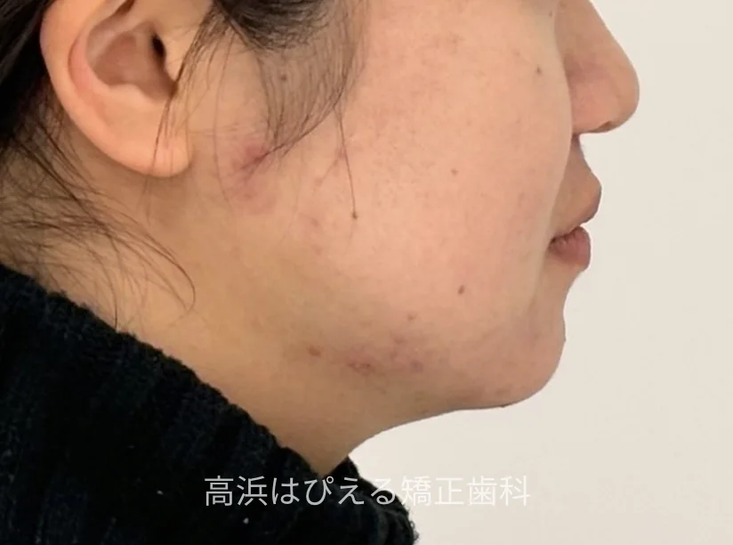 出っ歯・口ゴボ症例3の治療後の横顔写真