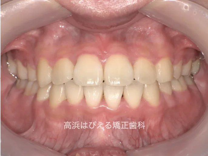 出っ歯・口ゴボ症例3の治療後の正面口腔内写真