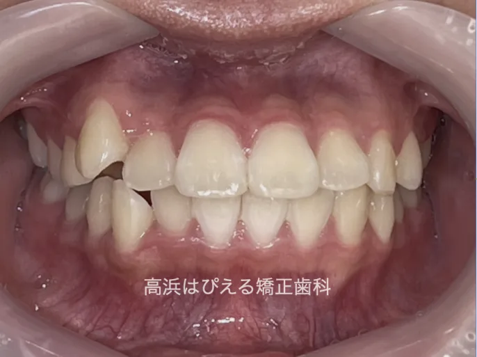 出っ歯・口ゴボ症例3の治療前の正面口腔内写真