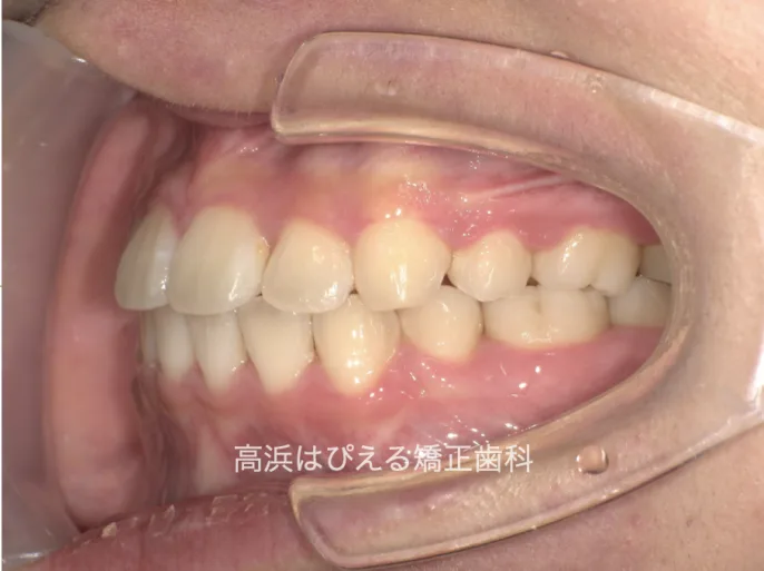 出っ歯・口ゴボ症例3の治療後の左側面口腔内写真