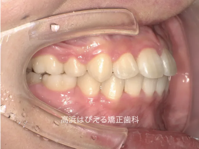 20歳女性の著しい口元の突出・叢生の治療後の右側面口腔内写真