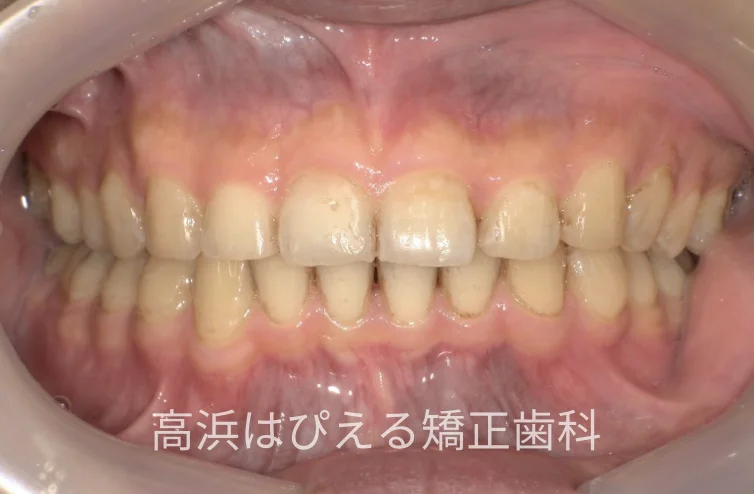41歳男性の重度の出っ歯の治療後の正面口腔内写真