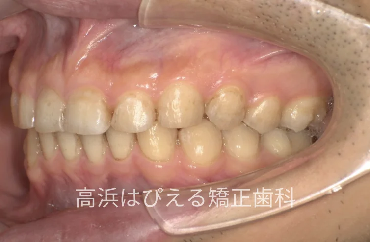 41歳男性の重度の出っ歯の治療後の左側面口腔内写真